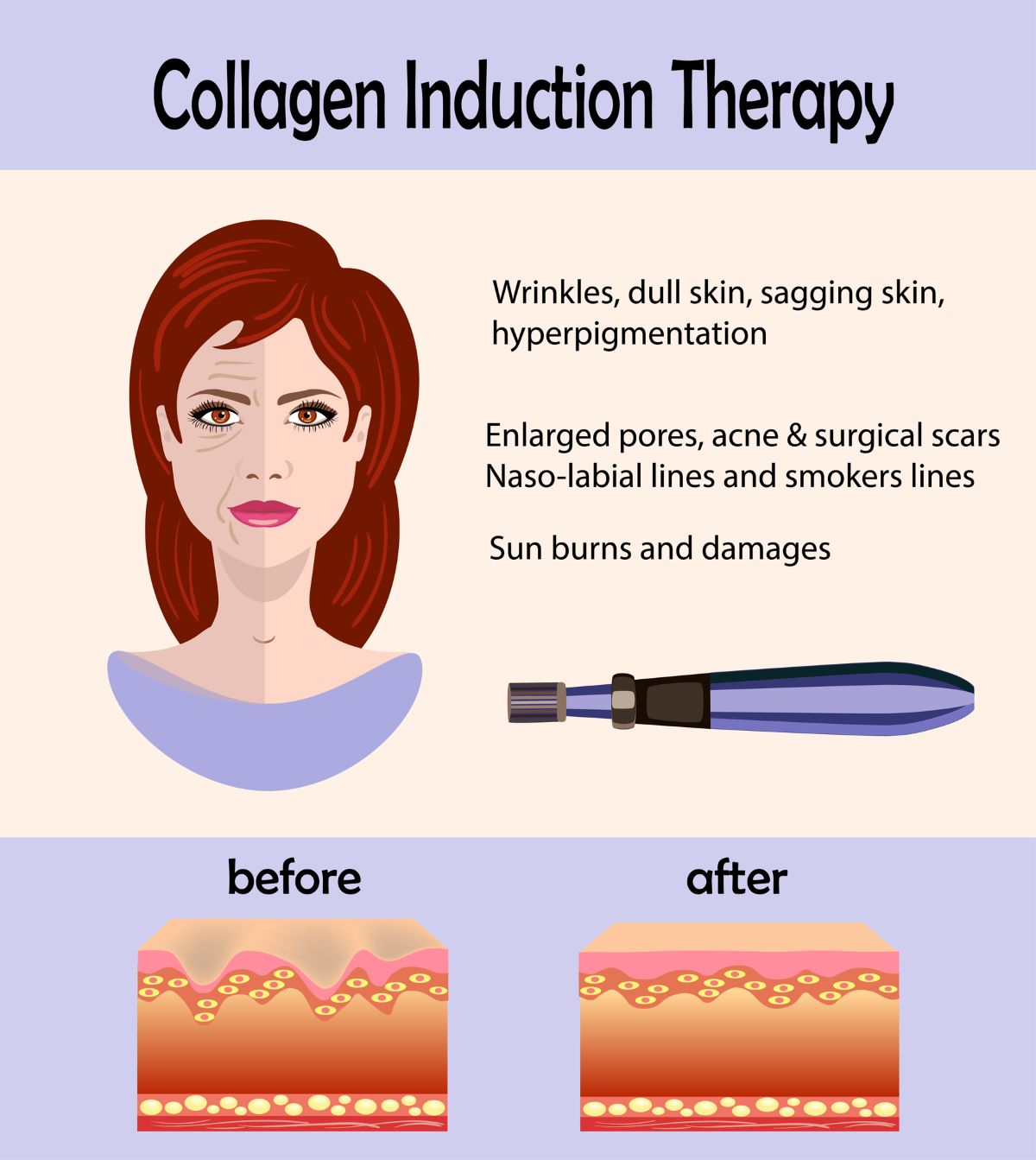 Collagen Induction Therapy drawing
